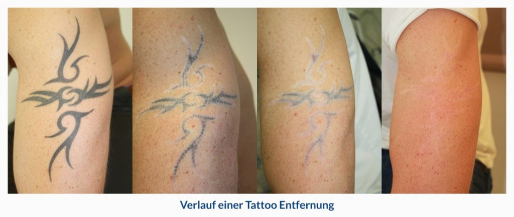 tattoo enfernen dr Hilton duesseldorf foto verlauf