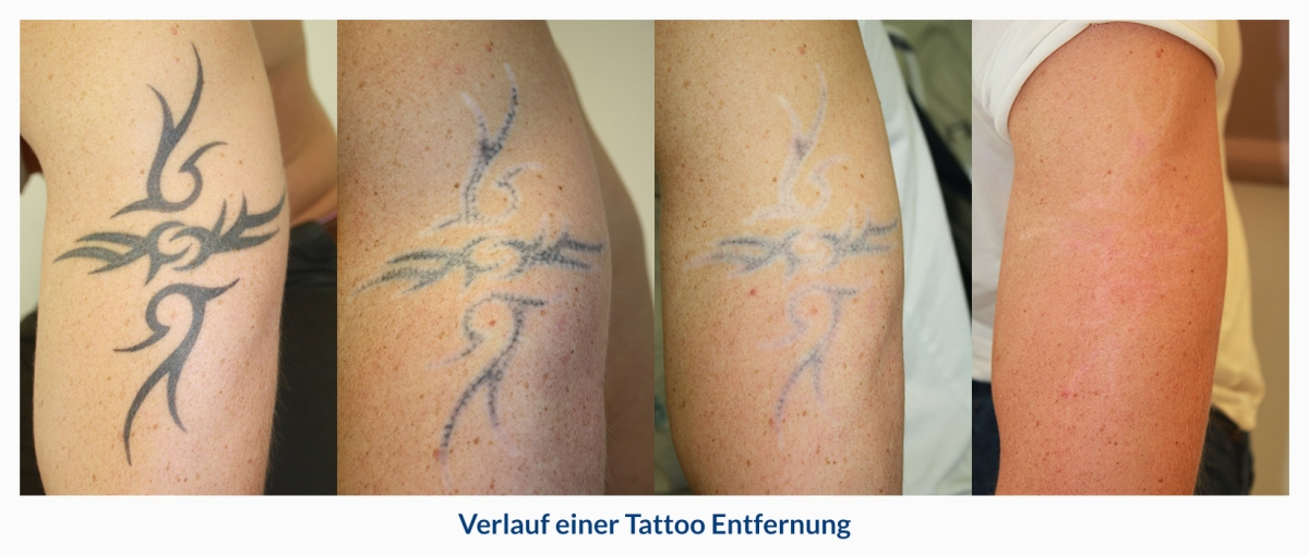 Tattoos entfernen Methoden zur professionellen Entfernung von